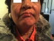 RELLENOS FACIALES
