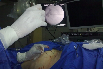 CIRUGIA PERCUTANEA REALIZACION DE LA PUNCION GUIADO POR FLUOROSCOPIA - Urólogo - Dr. Félix Padilla A...