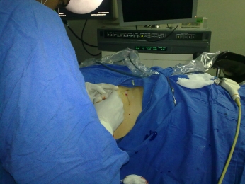 CIRUGIA PERCUTANEA REALIZACION DE LA PUNCION GUIADO POR FLUOROSCOPIA - Urólogo - Dr. Félix Padilla A...