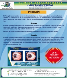 20% de descuento en Cirugía de Pterigión. - Láser Ocular Puebla - Puebla