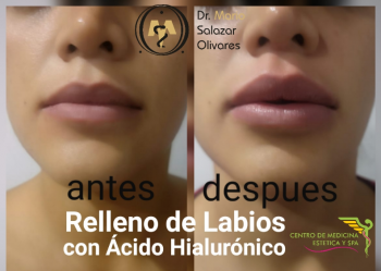 Cirugía estética y Bariatría en Puebla - Dr. Mario Salazar Olivares - Puebla