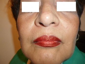 RESULTADOS DE 7 DIAS DESPUES DE LA APLICACION DE RELLENOS FACIALES, COMPLETO REJUVENECIMINETO - Ciru...
